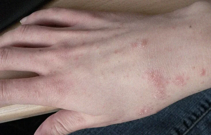 Qoturluq və ya Qotur Xəstəliyi haqqında (Scabies)