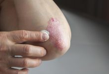 Psoriaz (Pullu dəmrov)