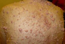 Neyrofibromatoz (Reklinqxauzen xəstəliyi)