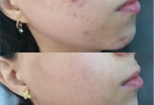 Acne Vulgaris