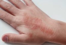 Dermatitis Herpetiformis