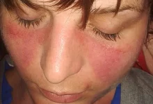 Qırmızı Qurd Eşənəyi (Lupus xəstəliyi) diaqnozu