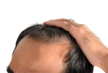 Androgenetik Alopesiya