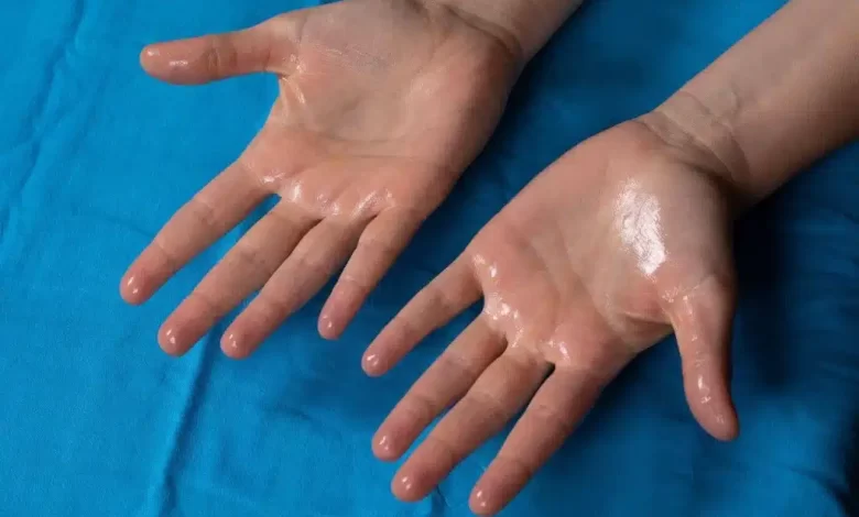 Hiperhidrozun (Həddindən artıq tərləmənin) növləri və simptomları