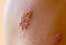 Herpes Zoster (Kəmərləyici Dəmrov) xəstəliyinin müalicəsi