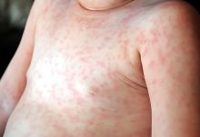Roseola İnfantum infeksiyasının qarşısının alınması