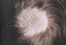 Tinea Capitis (Saçlı Dərinin Göbələyi)
