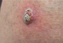 Squamos Cell Carcinoma (Yastıhüceyrəli Dəri Xərçəngi)