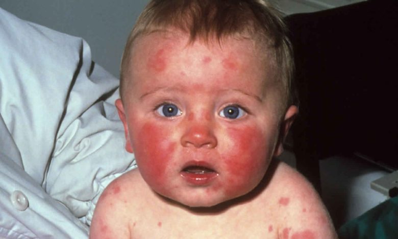 Erythema İnfectiosum
