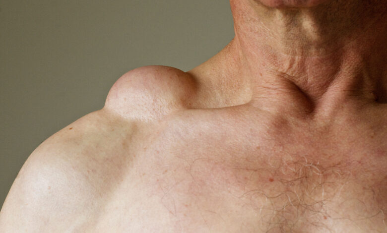 Lipoma nədir?